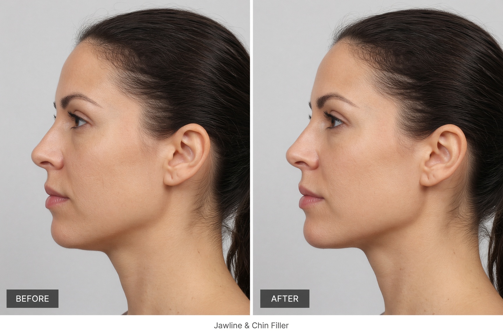 Före och efter jawline- och hakafiller – skarpare definition